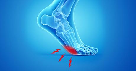 Numbness or Pain in the Ball of Your Foot? 3 Steps to Treat Neuromas Naturally