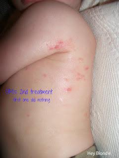 Eczema, Molluscum... please go away!