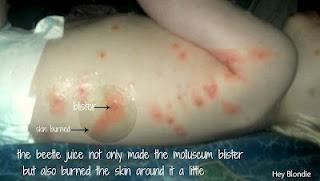 Eczema, Molluscum... please go away!