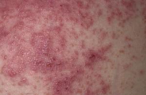 Living With Psoriasis And Dermatitis