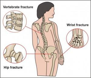 osteoporosis