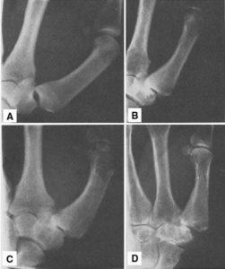 CMC Joint pain