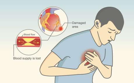 HOME REMEDIES FOR ANGINA