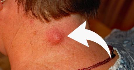 HOME REMEDIES FOR BOILS