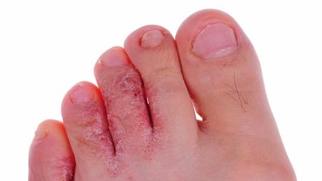 HOME REMEDIES FOR ATHLETES FOOT
