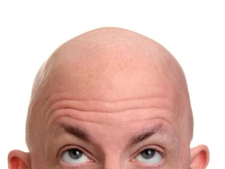 How to Deal with Insecurities After Hair Loss