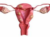 Home Remedies Fibroid