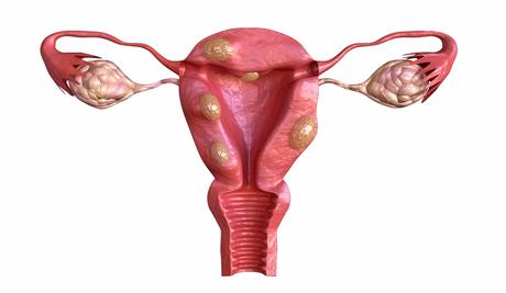 HOME REMEDIES FOR FIBROID HOME REMEDIES FOR FIBROID