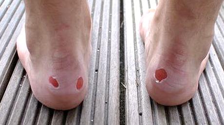 Home Remedies for foot blisters