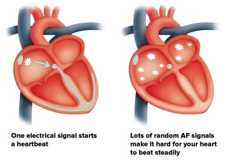 Atrial fibrillation