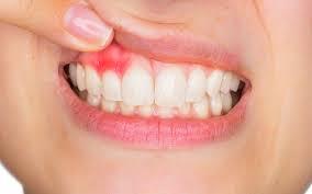 HOME REMEDIES FOR GUM DISEASE