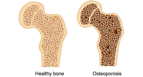 What is the treatment of Osteoporosis? What is the treatment of Osteoporosis?