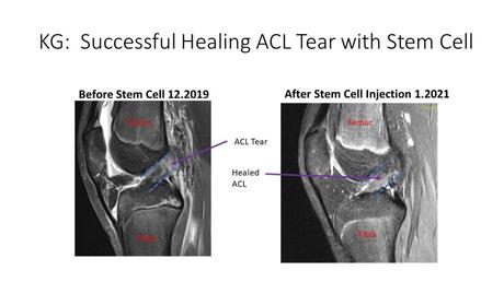 ACL Tear Treatment Without Surgery: The Truth You Need to Know!