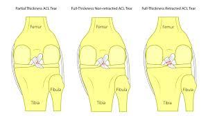 ACL Tear Treatment Without Surgery: The Truth You Need to Know!