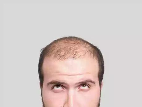 Cure for Balding