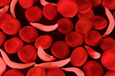 Sickle Cell Research to the Present and the Future