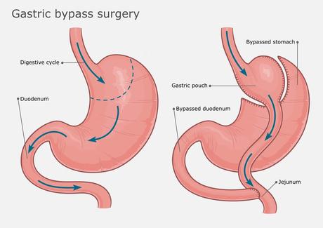 Bariatric surgery for metabolic health and weight loss