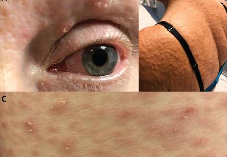 Treatment of Syphilis in Ayurveda with Herbal Remedies