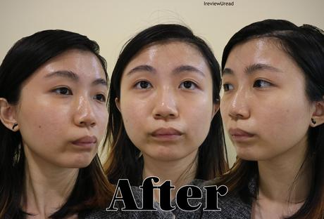 New Generation Chemical Peel in Singapore Review