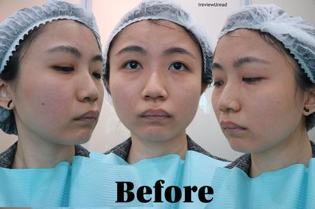 New Generation Chemical Peel in Singapore Review