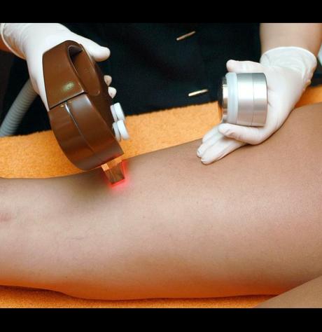 Body Hair Removal Methods, laser