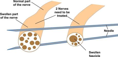 Nerve Hydrodissection:  An Exciting New Way to Treat Nerve Injuries!