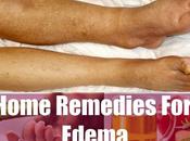 Home Remedies Edema