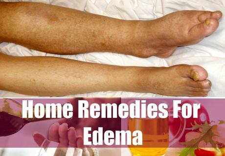 HOME REMEDIES FOR EDEMA