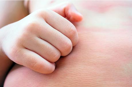Prevention and Treatment of Atopic Dermatitis (Eczema)