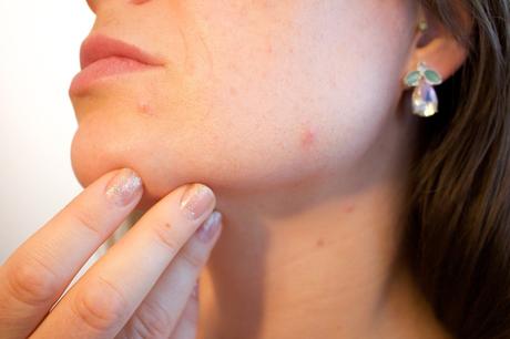 How to Get Rid of Painful Pimples 5 Ways