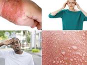 Herbal Remedies Impetigo Cellulitis Skin Infections)