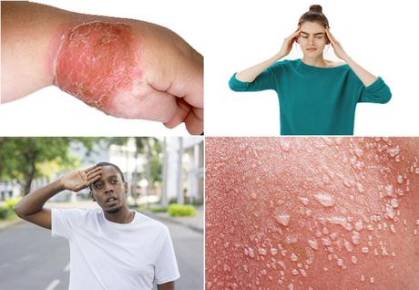 Herbal Remedies for Impetigo and Cellulitis ( Skin Infections)