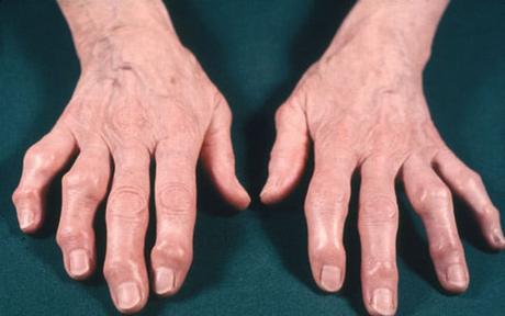 Rhemataoid Arthritis (Aama Vata)