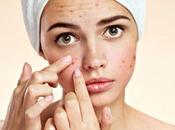 Acne Ayurveda