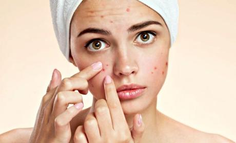 ACNE IN AYURVEDA