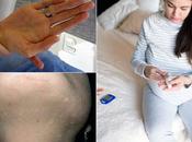 Natural Treatment Syringoma (benign Adnexal Tumor)