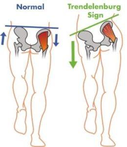 Gluteus Medius Pain: Is This the Cause of Your Butt Pain?