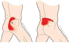 When a specific muscle is affected, it may lead to compensatory movements, fatigue, and a shooting and sharp pain felt on one side on your lower back and hip may be caused by muscle spasm, joint dysfunction, and/or nerve compression in. Treat Muscle Knots In Lower Back Tiger Tail Usa