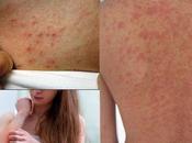 Alternative Medicines Dermatitis Herpetiformis (Skin Disorder)