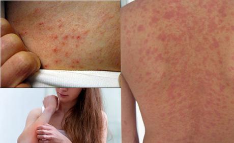 Alternative Medicines for Dermatitis Herpetiformis (Skin Disorder) Alternative Medicines for Dermatitis Herpetiformis (Skin Disorder)