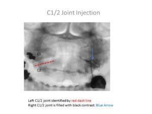 Craniocervical Instability Treatment: Another Success Story