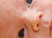 Baby Acne Causes, Symptoms, Treatments