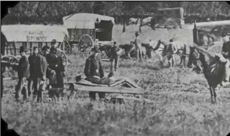 Amputations were Done Without Anesthesia Amputations were Done Without Anesthesia