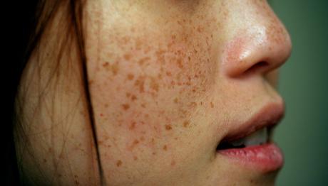 How To Remove Dark Spots on Face Overnight Home Remedies