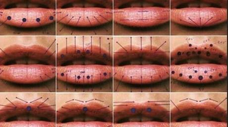 Frequently Asked Questions Regarding Lip Enhancement and Lip Fillers