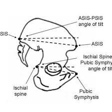 This page is about the various possible meanings of the acronym, abbreviation, shorthand or slang term: Schematic Diagram Of The Pelvis Illustrating The Asis Psis Measure Of Download Scientific Diagram