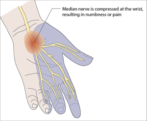 prp for carpal tunnel