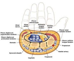 PRP for Carpal Tunnel Syndrome