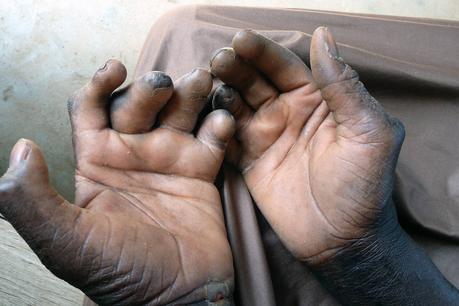 Leprosy (Kushtha)