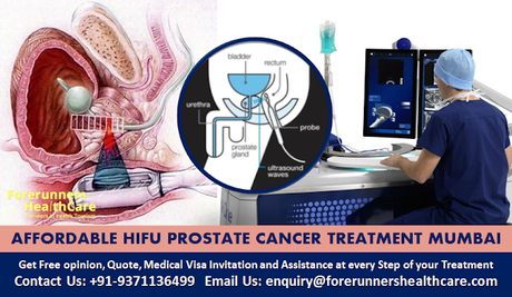 Best Cost HIFU Prostate Cancer Treatment in India